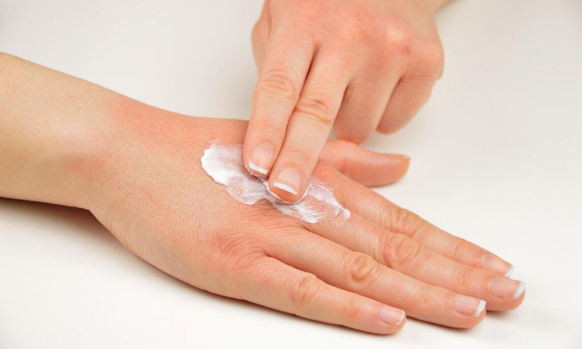 Tratamiento de la psoriasis con crema Keramin.