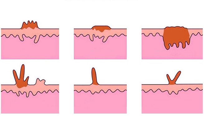 tipos de papilomas en el cuerpo