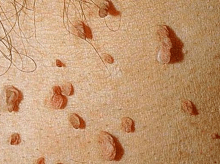 Papilomas en el cuerpo.