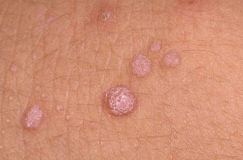 Síntomas del virus del papiloma humano