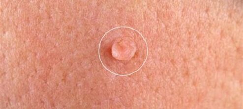 verrugas genitales en el cuerpo